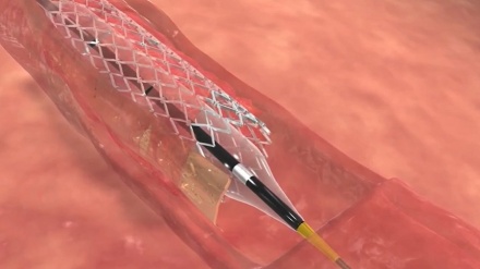 Жүрек-қан тамырларын ұстағыштар ирандық ғалым әйелдің қолымен жасалды